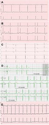 Oral theophylline corrects sinus node dysfunction in acute on chronic lithium toxicity: case report and systematic review of lithium-induced Sinus node dysfunction